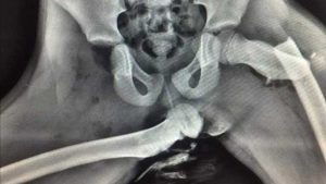 X-Ray Buktikan Airbag Mengembang + Kaki Di Dasbor = Fatal!